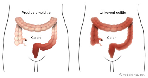 ulcerative colitis